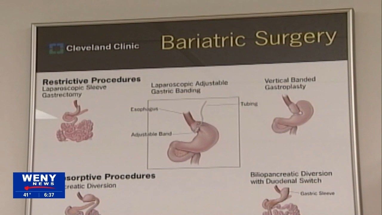 Different types of weight loss surgeries available WENY News